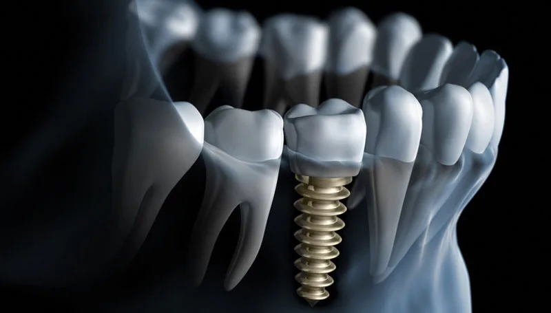 Dental Implant Design 2