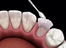 Regenerative product bone graft