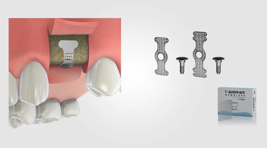 Titanium Membrane 3 - Marks Biotech