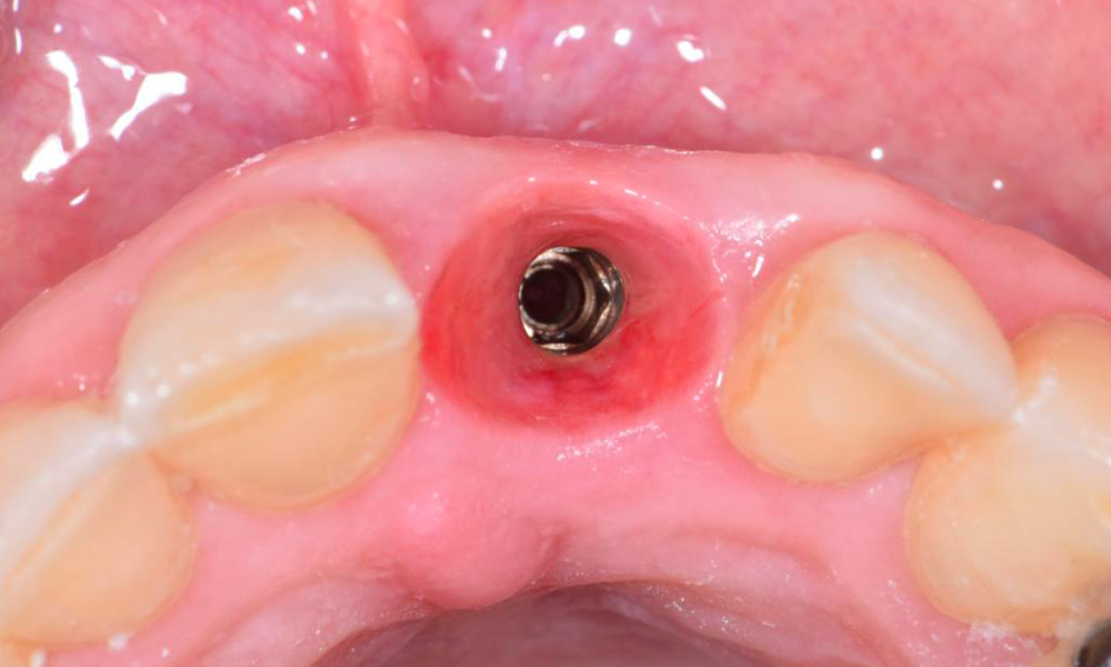 Morse Tapered Connection Implants