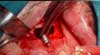 Safety Membranes - Clinical Case