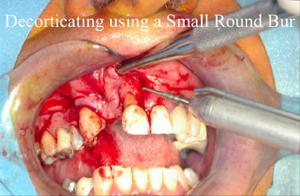 Dr Struart Orton Jones case on Bone Grafting with Rocky Mountain Allografts